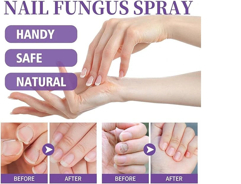 Nail Fungus Spray